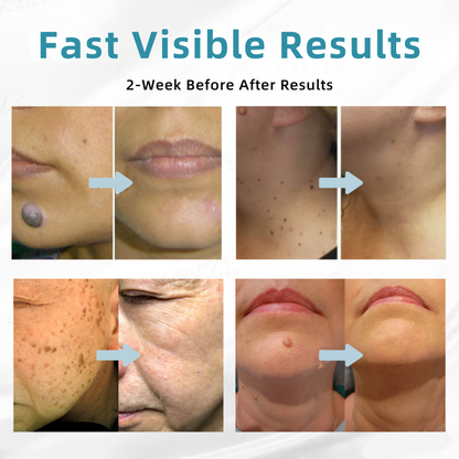 𝐉𝐚𝐬𝐬𝐞𝐞𝐦® Medical-Grade Laser Pen 💕 (Powered by advanced CO₂ laser technology – safely and effectively removes moles, warts, skin tags, pigmentation marks, and other common skin concerns)