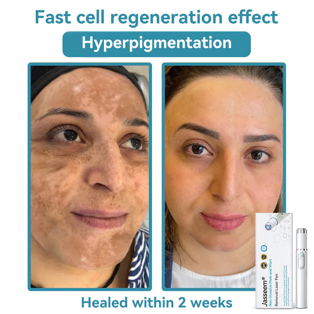 𝐉𝐚𝐬𝐬𝐞𝐞𝐦® Medical-Grade Laser Pen 💕 (Powered by advanced CO₂ laser technology – safely and effectively removes moles, warts, skin tags, pigmentation marks, and other common skin concerns)