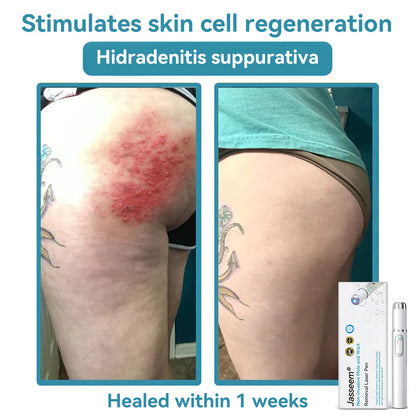 𝐉𝐚𝐬𝐬𝐞𝐞𝐦® Medical-Grade Laser Pen 💕 (Powered by advanced CO₂ laser technology – safely and effectively removes moles, warts, skin tags, pigmentation marks, and other common skin concerns)