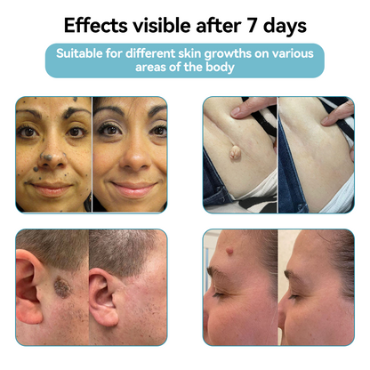 𝐉𝐚𝐬𝐬𝐞𝐞𝐦® Medical-Grade Laser Pen 💕 (Powered by advanced CO₂ laser technology – safely and effectively removes moles, warts, skin tags, pigmentation marks, and other common skin concerns)