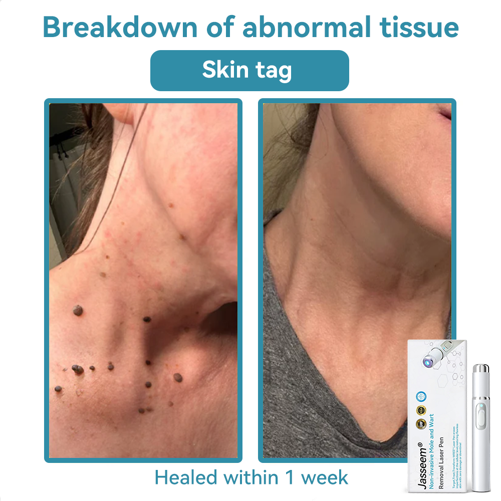 𝐉𝐚𝐬𝐬𝐞𝐞𝐦® Medical-Grade Laser Pen 💕 (Powered by advanced CO₂ laser technology – safely and effectively removes moles, warts, skin tags, pigmentation marks, and other common skin concerns)