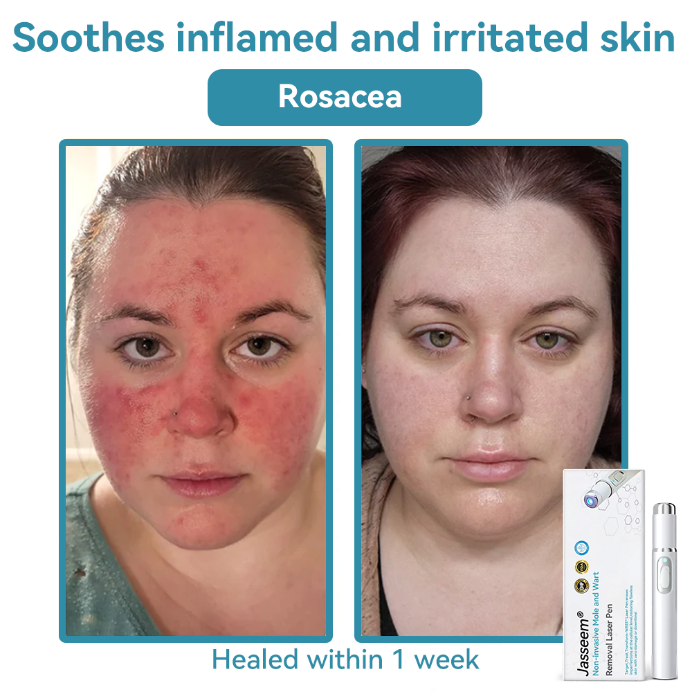 𝐉𝐚𝐬𝐬𝐞𝐞𝐦® Medical-Grade Laser Pen 💕 (Powered by advanced CO₂ laser technology – safely and effectively removes moles, warts, skin tags, pigmentation marks, and other common skin concerns)
